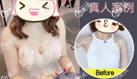 傲諾拉225cc假體隆胸一年后效果圖