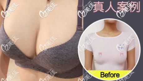 傲諾拉璀璨水滴形225cc假體隆胸6個(gè)月前后對(duì)比照片