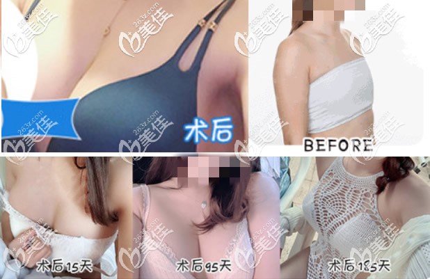 曼托假體隆胸前后對(duì)比照片