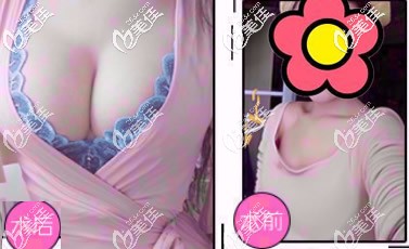 曼托假體隆胸兩年恢復圖