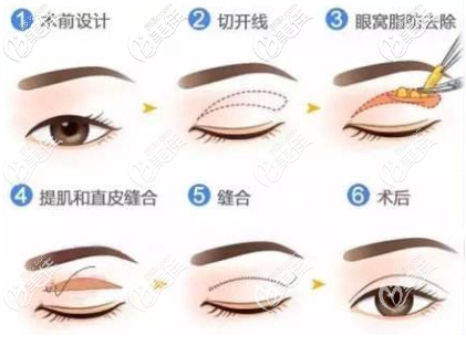 切開雙眼手術原理 切開雙眼手術原理