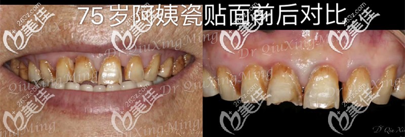 75歲阿姨瓷貼面前牙齒的照片 75歲阿姨瓷貼面前牙齒的照片