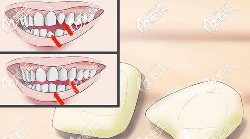 前牙缺損做瓷貼面效果好 前牙缺損做瓷貼面效果好