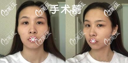 術(shù)前照 術(shù)前照