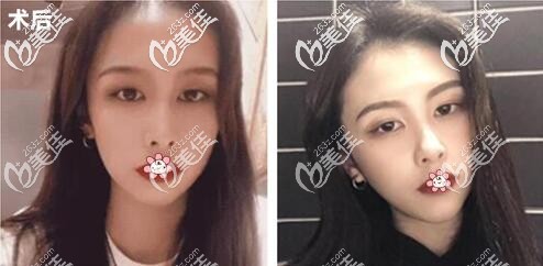 何照華磨骨削骨好不好 何照華磨骨削骨好不好