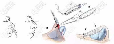 肋軟骨隆鼻的原理 肋軟骨隆鼻的原理