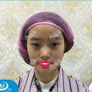 術(shù)前面部皮膚松弛下垂顯老 術(shù)前面部皮膚松弛下垂顯老