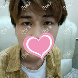 埋線重瞼術(shù)后6個月大小眼不對稱 埋線重瞼術(shù)后6個月大小眼不對稱