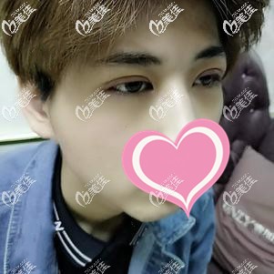 眼修復7天到院拆線依舊腫脹 眼修復7天到院拆線依舊腫脹