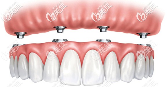 全口半固定和全固定種植牙的區(qū)別