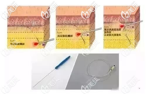 光纖溶脂的原理 光纖溶脂的原理