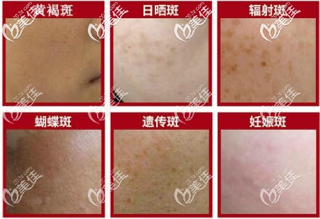 面部各種斑點(diǎn)的分類(lèi) 面部各種斑點(diǎn)的分類(lèi)