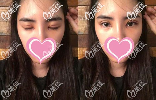 雙眼皮手術(shù)后恢復(fù)一周