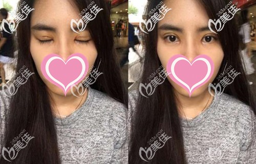 雙眼皮手術(shù)后恢復(fù)半個(gè)月