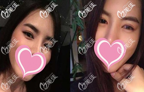 雙眼皮手術(shù)后恢復(fù)半年