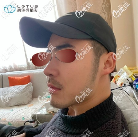 術(shù)后一個月遇上了植胡須后的脫落期