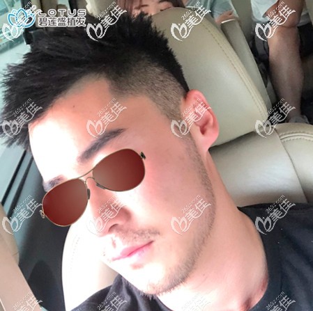 做植胡子手術(shù)一年后后悔死了!原本感覺胡須種植太可怕一直沒去做，白瞎丑了那么多年