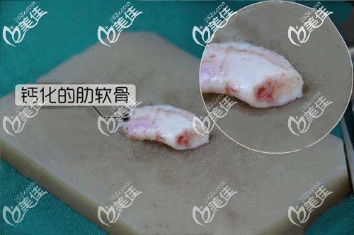 朋友發(fā)給我的鈣化肋軟骨 朋友發(fā)給我的鈣化肋軟骨