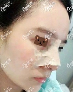 肋軟骨隆鼻術(shù)后即刻效果 肋軟骨隆鼻術(shù)后即刻效果