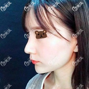 隆鼻術(shù)后12天鼻子挺拔但僵硬 隆鼻術(shù)后12天鼻子挺拔但僵硬