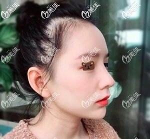 肋軟骨隆鼻30天疤痕漸消 肋軟骨隆鼻30天疤痕漸消