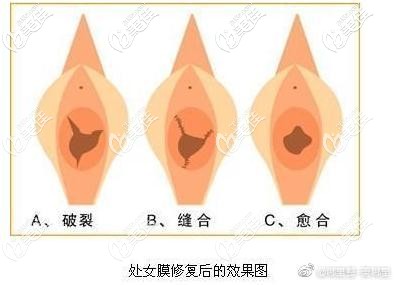 修處手術(shù)后效果對比圖