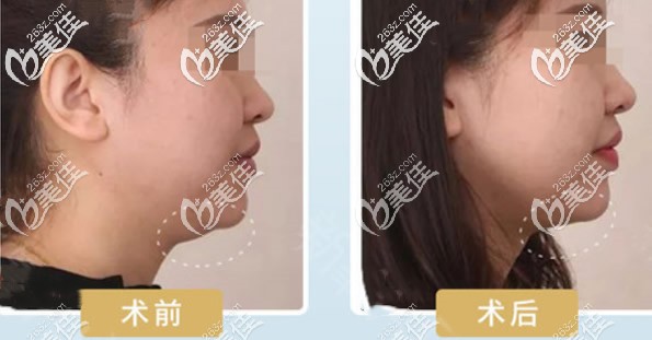 第四代熱瑪吉提升下頜緣效果圖 第四代熱瑪吉提升下頜緣效果圖