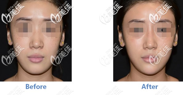 貝麗姿玻尿酸隆鼻墊下巴前后對比照片 貝麗姿玻尿酸隆鼻墊下巴前后對比照片