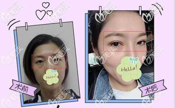 沒有眼袋，才能讓媽媽重返“年輕”