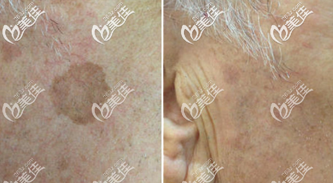 PicoWay超皮秒祛斑案例