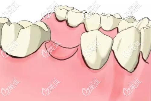 牙齒缺失外觀圖 牙齒缺失外觀圖