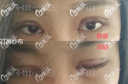 割雙眼皮術(shù)后第二天拆掉紗布效果圖