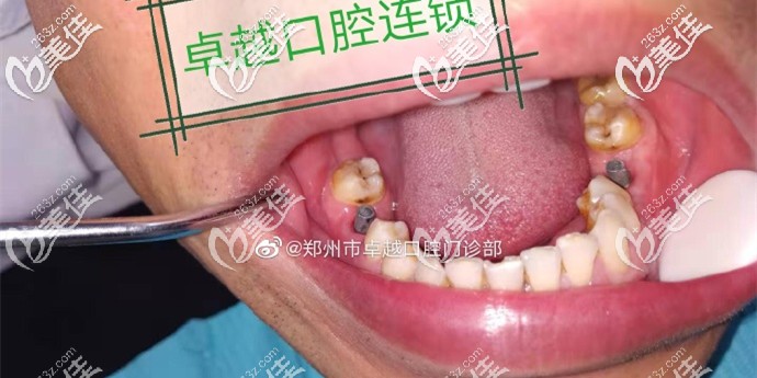 種植牙基臺已安裝 種植牙基臺已安裝