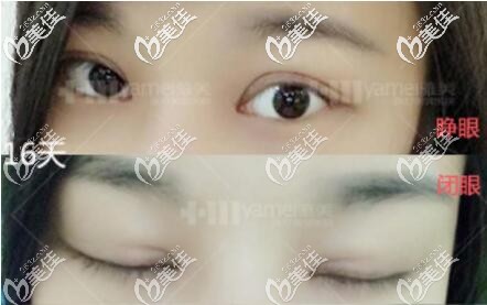 割雙眼皮術(shù)后16天恢復(fù)效果圖