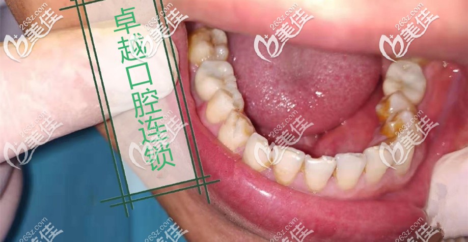 我的兩顆后磨牙缺失選擇的是德國瑞西歐種植牙，是五級鈦植體哦