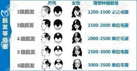 不同級(jí)別脫發(fā)所需的毛囊數(shù)量 不同級(jí)別脫發(fā)所需的毛囊數(shù)量