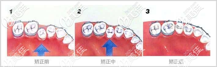 牙齒矯正過程