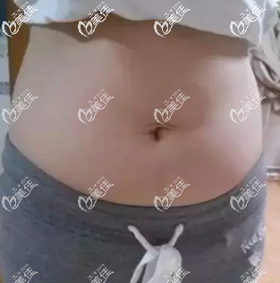 我做腰腹水動(dòng)力吸脂術(shù)前照片 我做腰腹水動(dòng)力吸脂術(shù)前照片