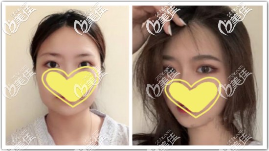 做完面部光纖溶脂三個(gè)月效果對(duì)比圖 做完面部光纖溶脂三個(gè)月效果對(duì)比圖