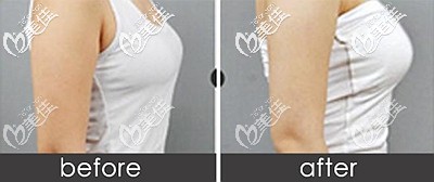 做麥格假體隆胸后的效果對比