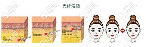 光纖溶脂原理示意圖