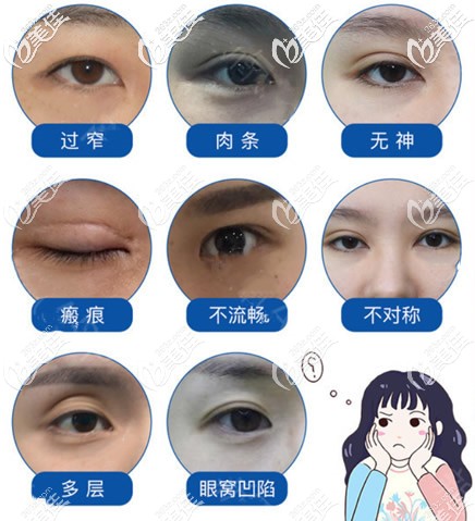 雙眼皮失敗的八種圖片 雙眼皮失敗的八種圖片