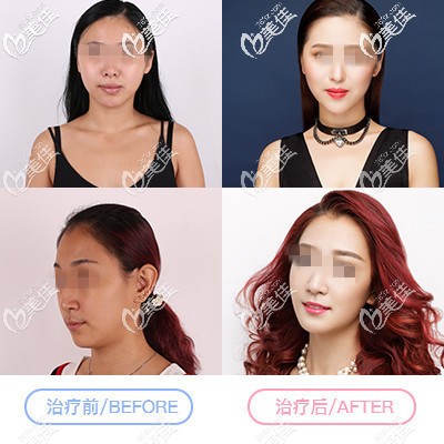 面部脂肪填充對比案例 面部脂肪填充對比案例