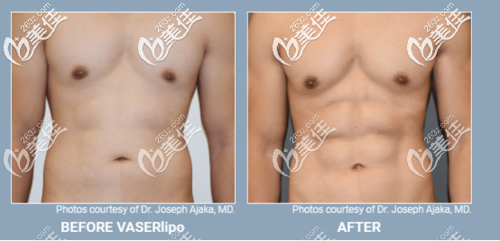 威塑超聲吸脂男性案例 威塑超聲吸脂男性案例