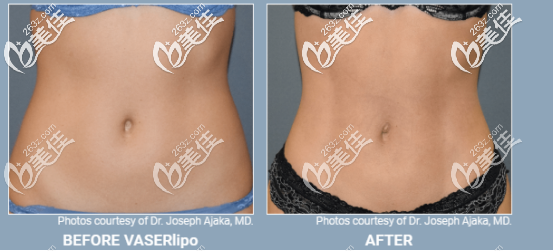 威塑超聲吸脂女性案例 威塑超聲吸脂女性案例