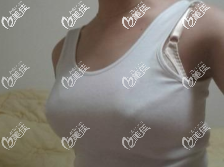 做曼托毛面500cc假體隆胸一年后效果圖