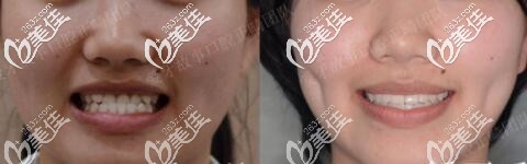 溫州愛(ài)牙故事地包天牙齒矯正真人案例