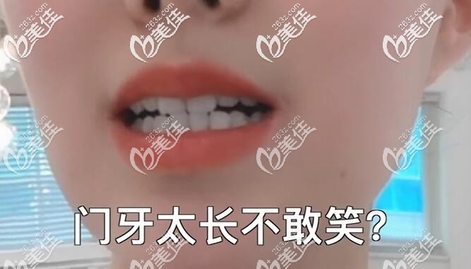 門牙太長怎么矯正 門牙太長怎么矯正