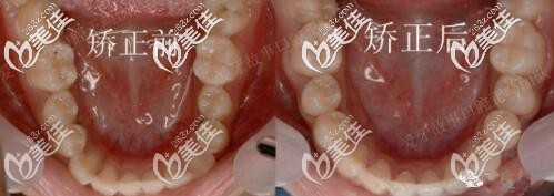 溫州愛(ài)牙故事牙齒矯正真人案例