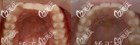 溫州愛(ài)牙故事口腔門(mén)診部正畸真人案例